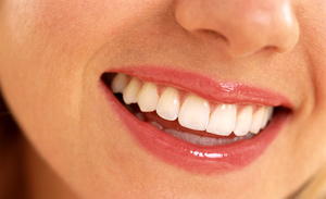 Teeth Whitening Abbotsford